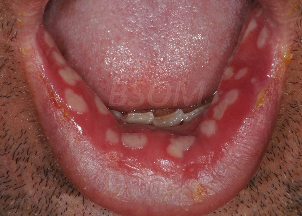 Sudden Onset Painful Mouth Ulcers Herpes British & Irish Society