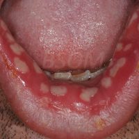 Sudden Onset Painful Mouth Ulcers – Herpes