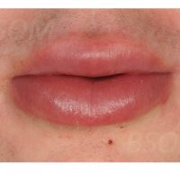 Mouth Ulcers and Lip Swelling