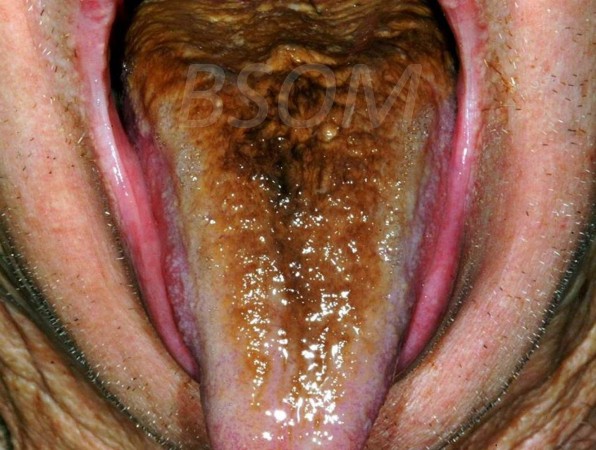 Black Tongue