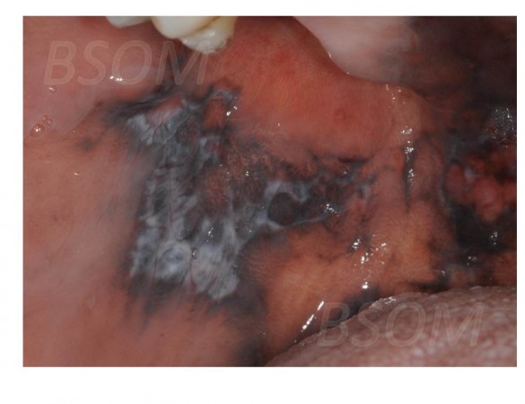 Oral Pigmented Lesion