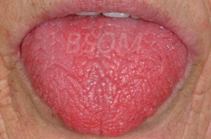 Dry Mouth – Sjogren’s Syndrome