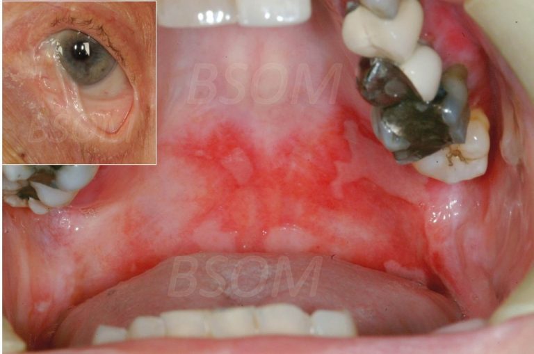 sore-mouth-pemphigoid-british-irish-society-for-oral-medicine