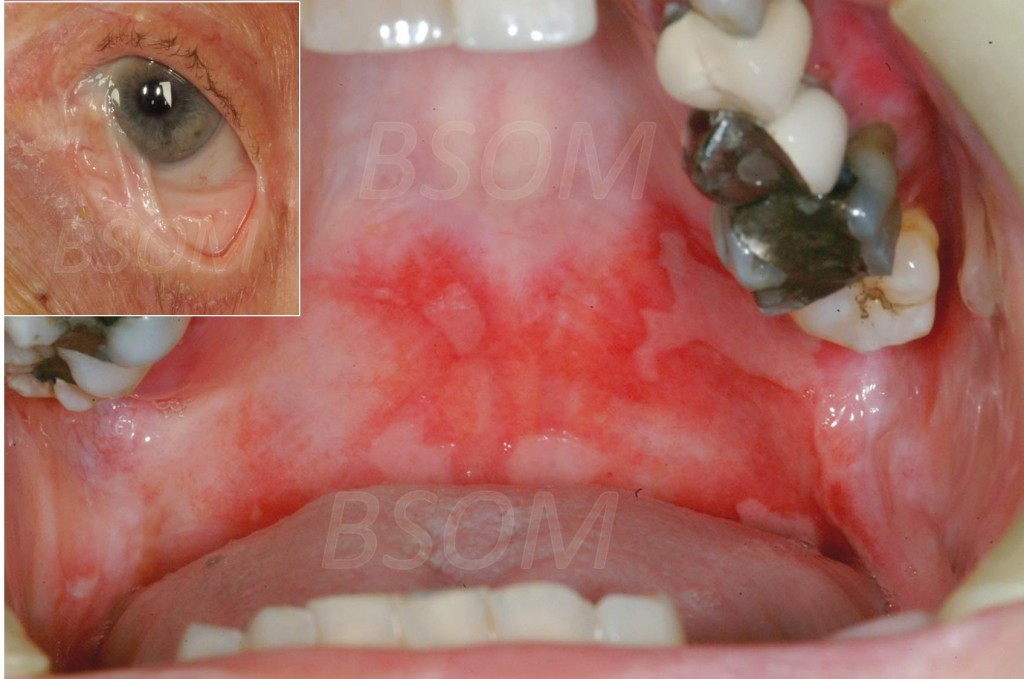 Oral Pemphigus