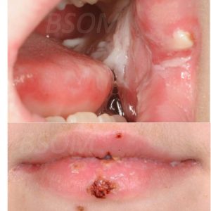 Sore Mouth – Erythema Multiforme