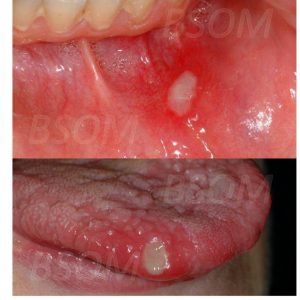 Recurrent Mouth Ulcers