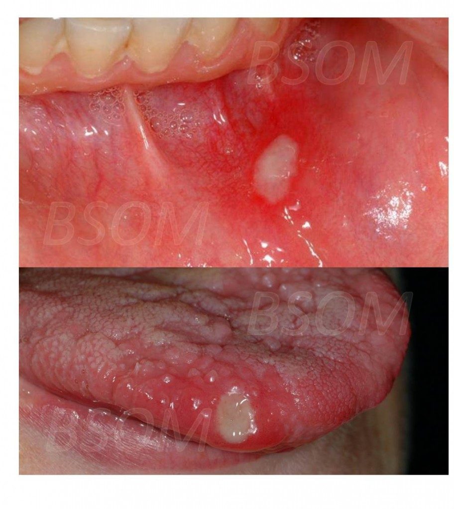 Recurrent Mouth Ulcers