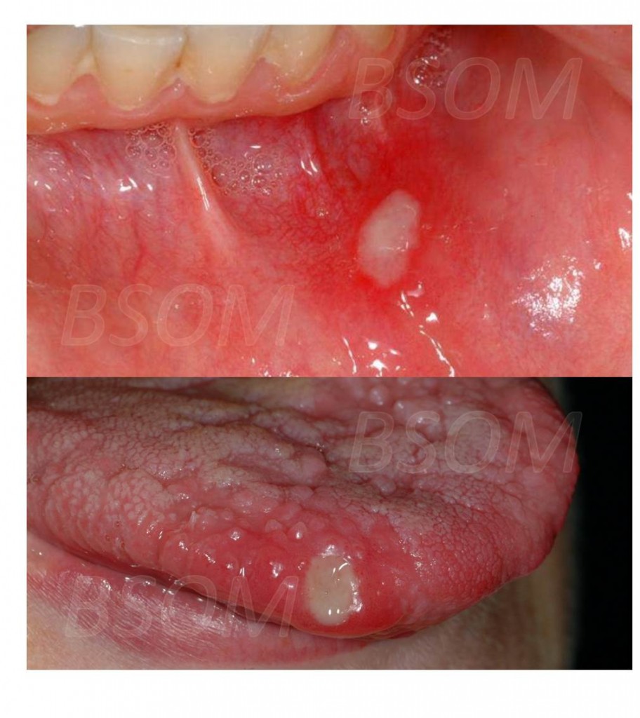Recurrent Mouth Ulcers British & Irish Society for Oral Medicine