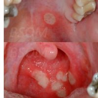 Recurrent Mouth Ulcers – Behcet’s Disease