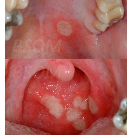 Recurrent Mouth Ulcers – Behcet’s Disease