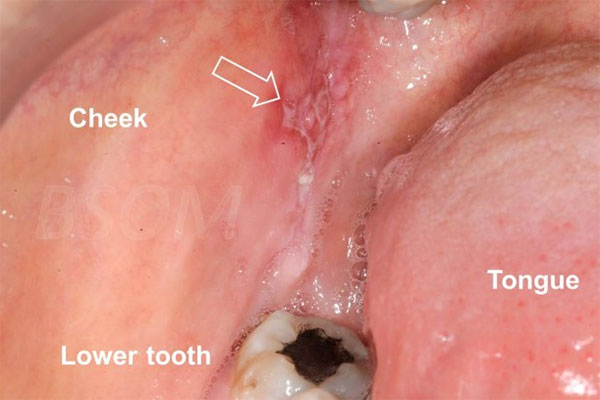 mouth cancer