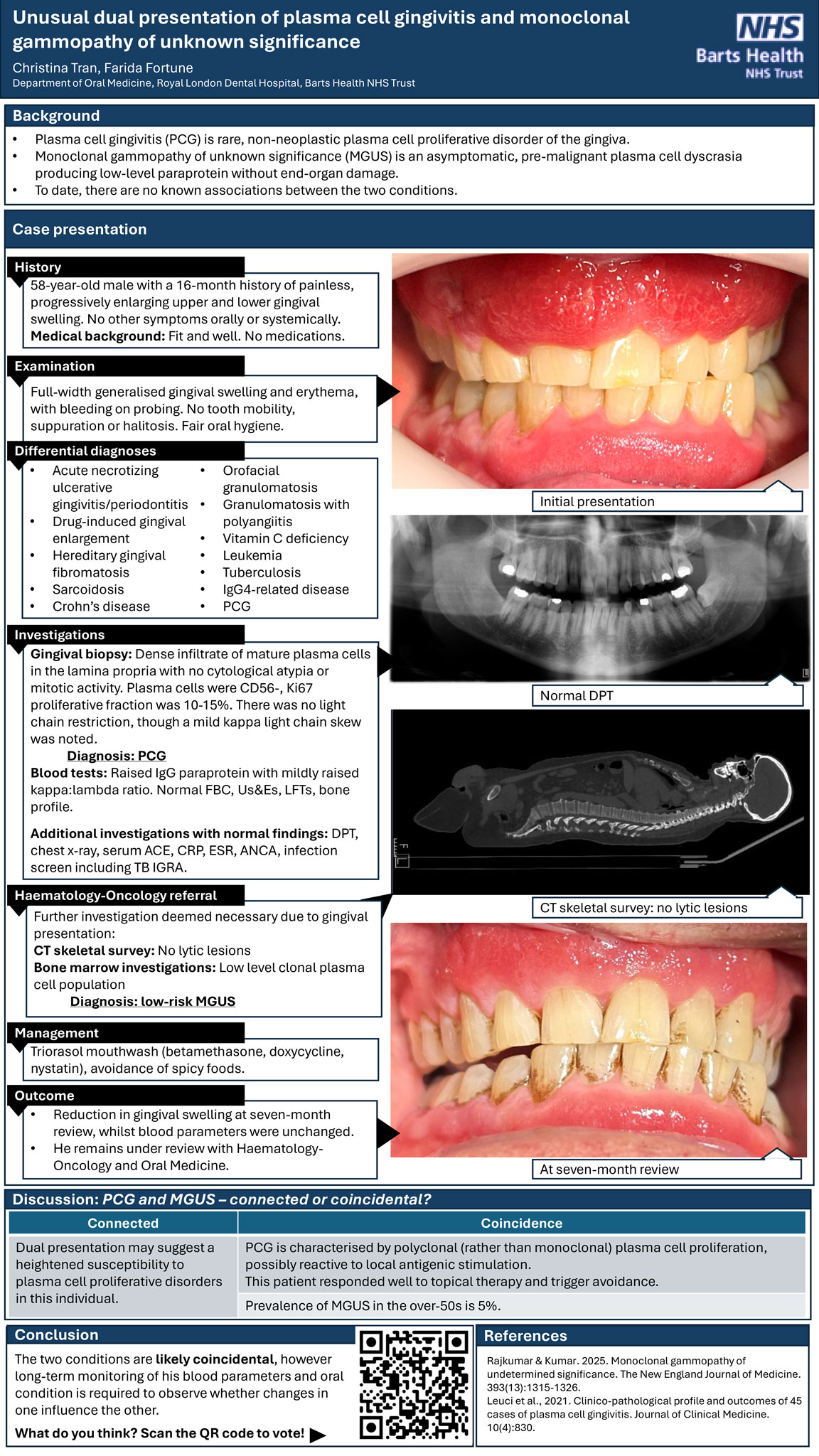 Unusual dual presentation of plasma cell gingivitis and monoclonal gammopathy of unknown significance