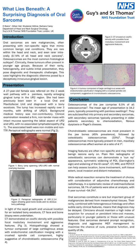 What lies beneath: A Surprising Diagnosis of Oral Sarcoma