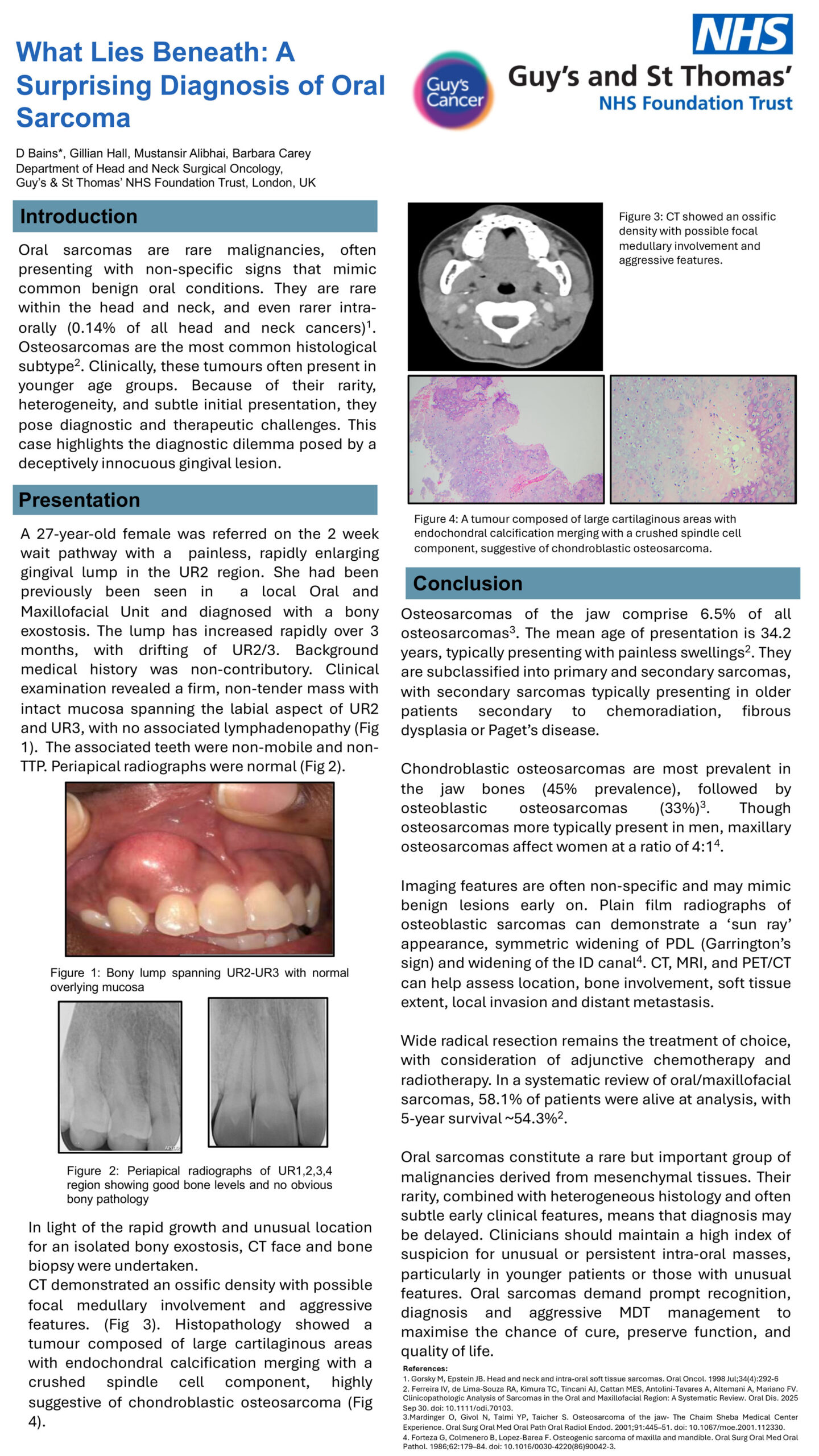 What lies beneath: A Surprising Diagnosis of Oral Sarcoma