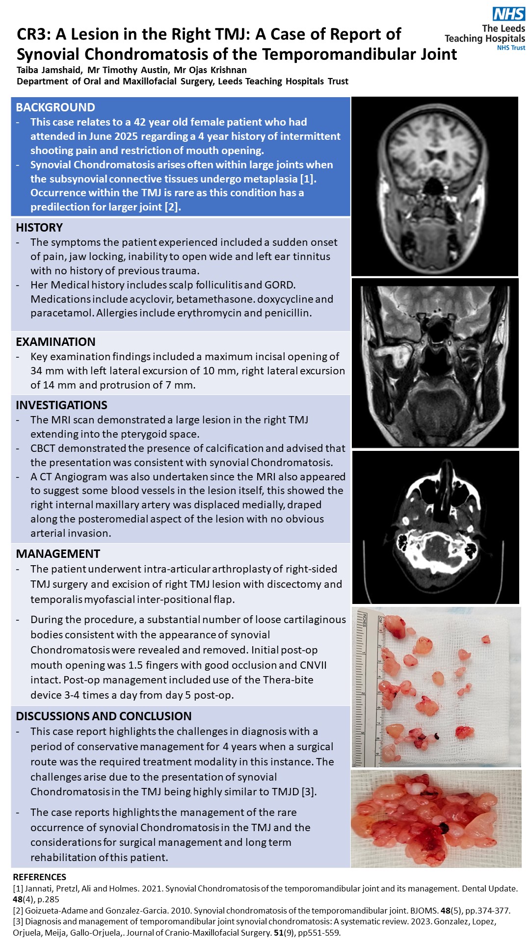 Synovial-Chondromatosis-Case-Report-BISOM-Poster
